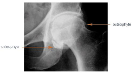 Coxarthrose débutante