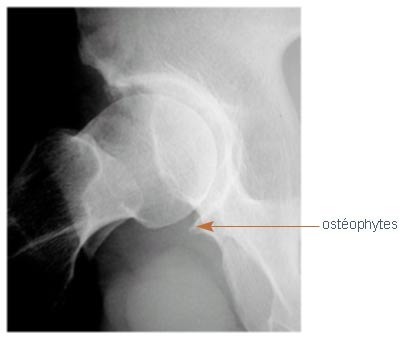 Coxarthrose débutante