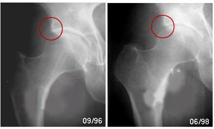 Coxarthrose débutante