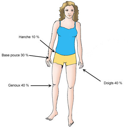 La coxarthrose