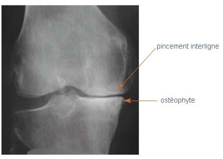Gonarthrose fémoro-tibiale interne 