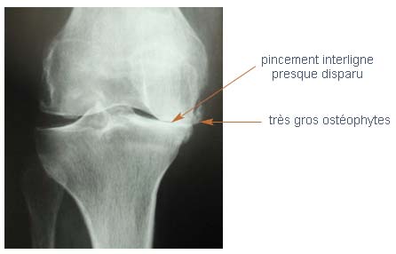 gonarthrose