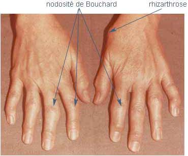 Types d'arthrose - Mon arthrose