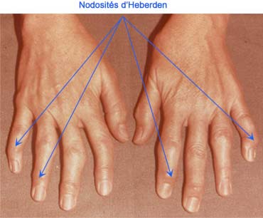 Nodosités d'Heberden