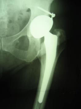 Prothèse implantée