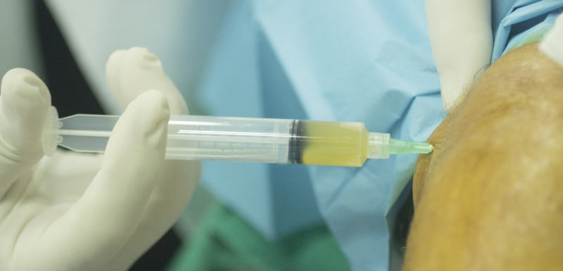 Arthrose du genou : une nouvelle thérapie cellulaire injectable fait ses  preuves