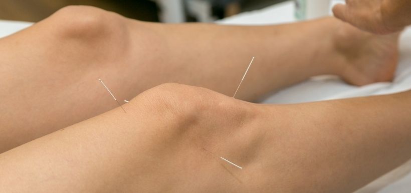 Arthrose du genou symptomatique : et l’acupuncture ?