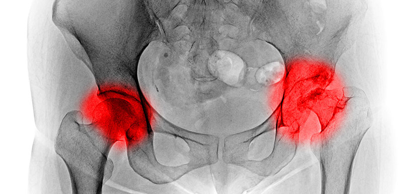 Arthrose de la hanche : l’efficacité d’une injection intramusculaire de corticoïdes